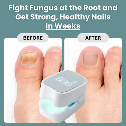 RushifyNail Pro™ - Nail Fungus Laser Device