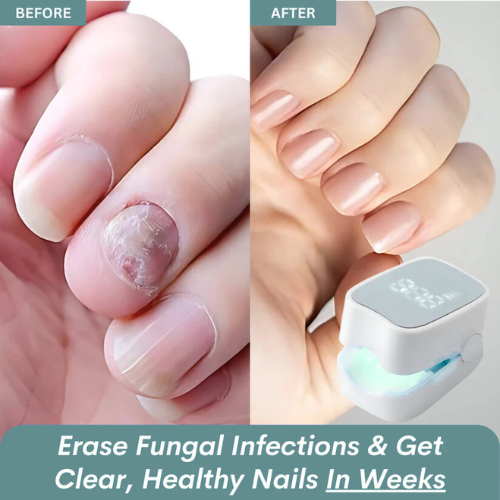 RushifyNail Pro™ - Nail Fungus Laser Device