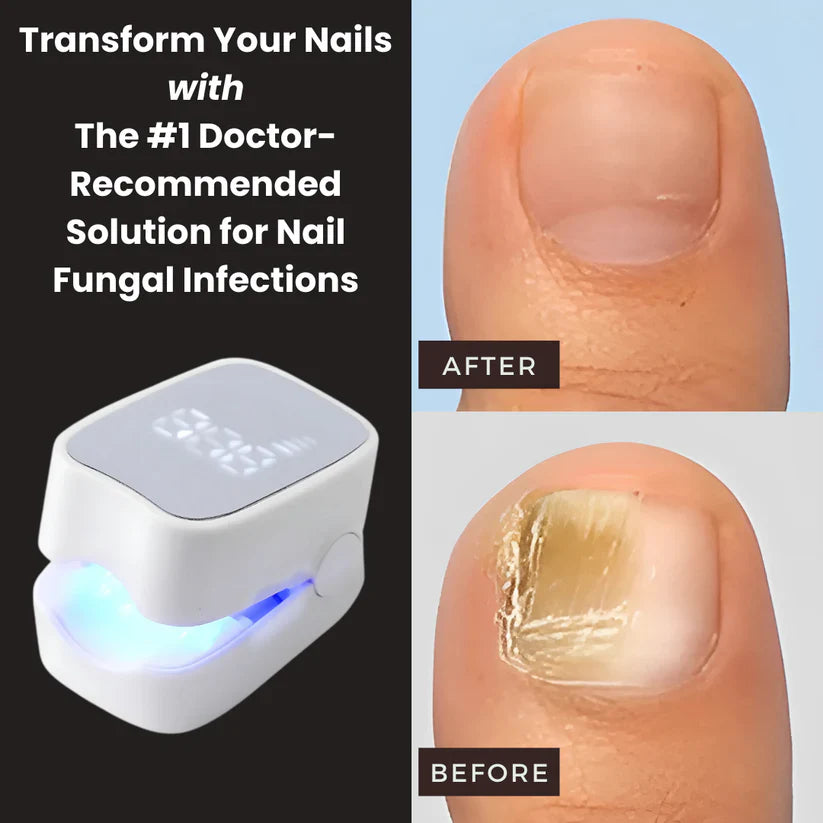 RushifyNail Pro™ - Nail Fungus Laser Device