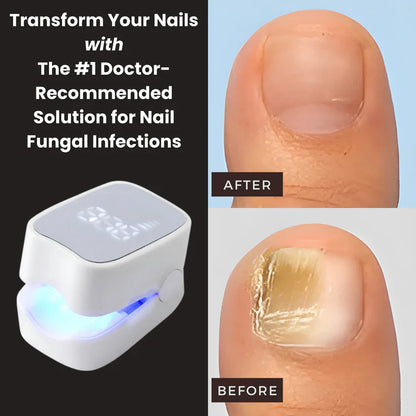 RushifyNail Pro™ - Nail Fungus Laser Device